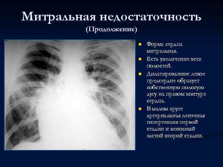 Митральная недостаточность (Продолжение) n n Форма сердца митральная. Есть увеличение всех полостей. Дилатированное левое