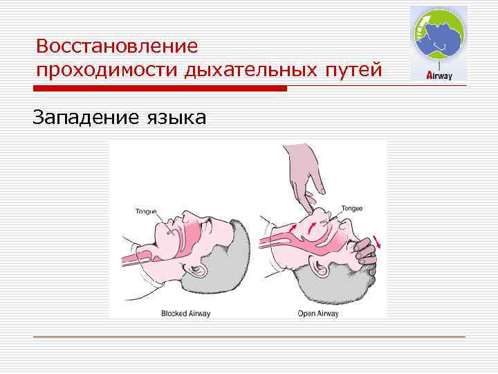 Восстановление проходимости дыхательных путей Западение языка 