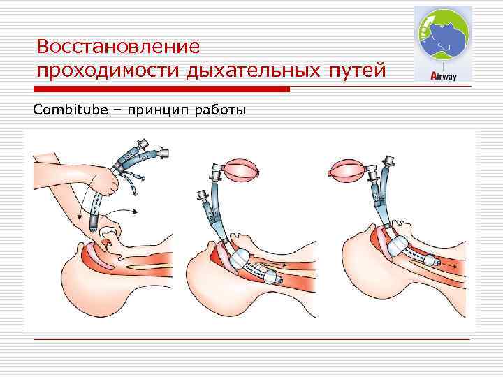 Восстановление проходимости дыхательных путей Combitube – принцип работы 