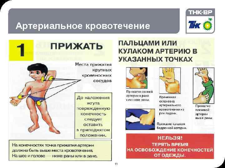 09: 09 © THK-BP presentation name Артериальное кровотечение • 1 11 