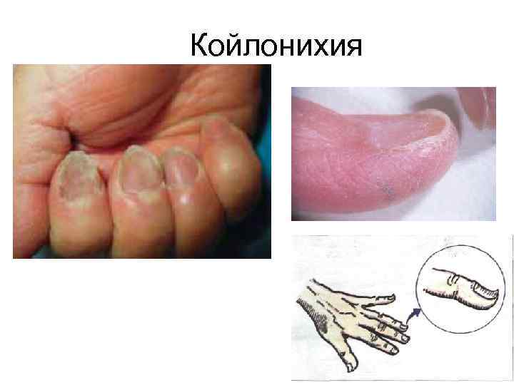 Койлонихия 