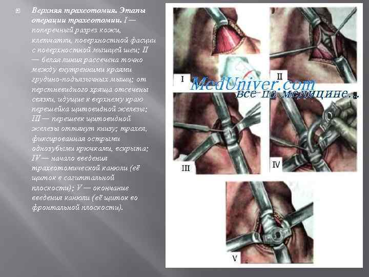 Верхняя трахеотомия. Этапы операции трахеотомии. I — поперечный разрез кожи, клетчатки, поверхностной фасции