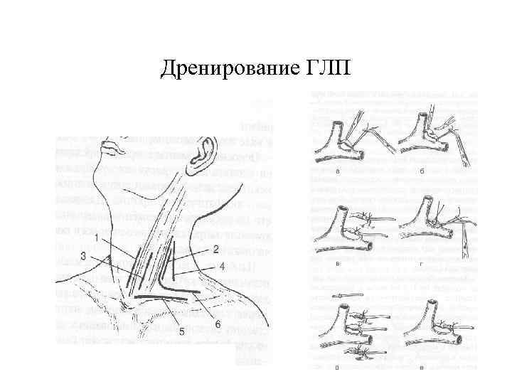 Дренирование ГЛП 