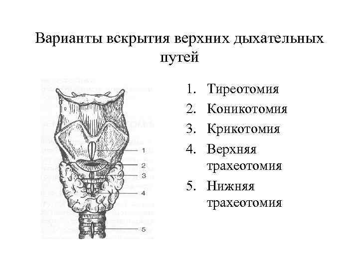 Трахеотомия