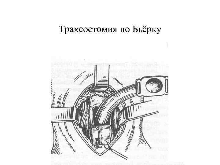 Трахеостомия по Бьёрку 