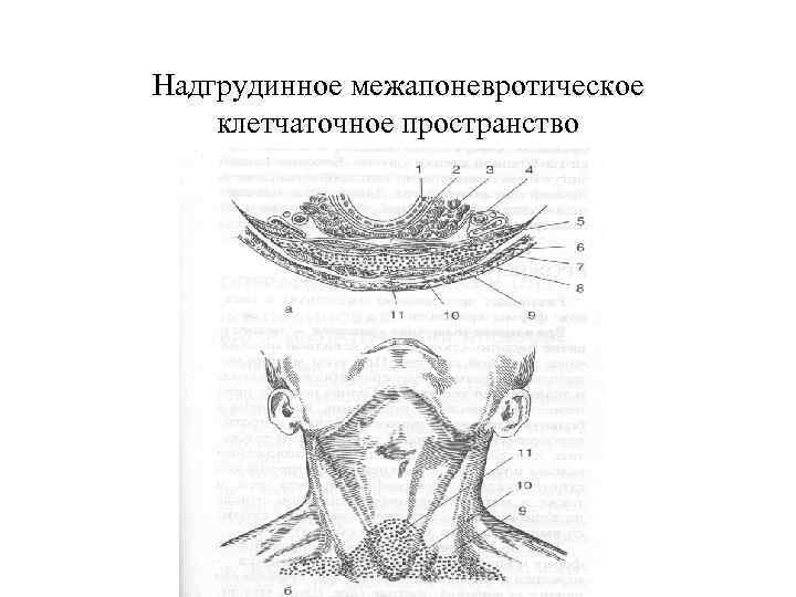 Надгрудинное межапоневротическое клетчаточное пространство 