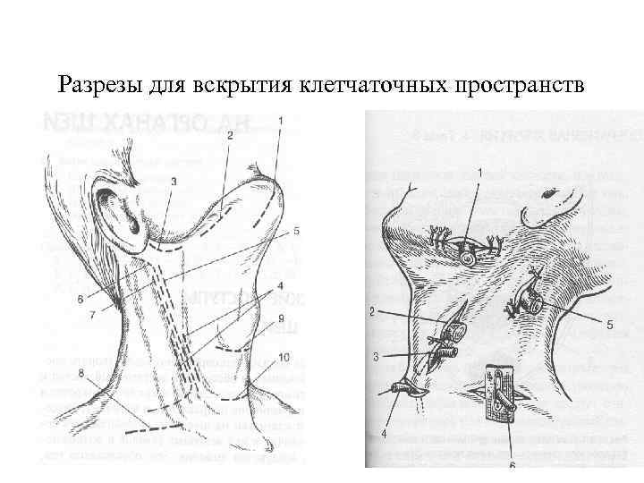 Разрезы для вскрытия клетчаточных пространств 