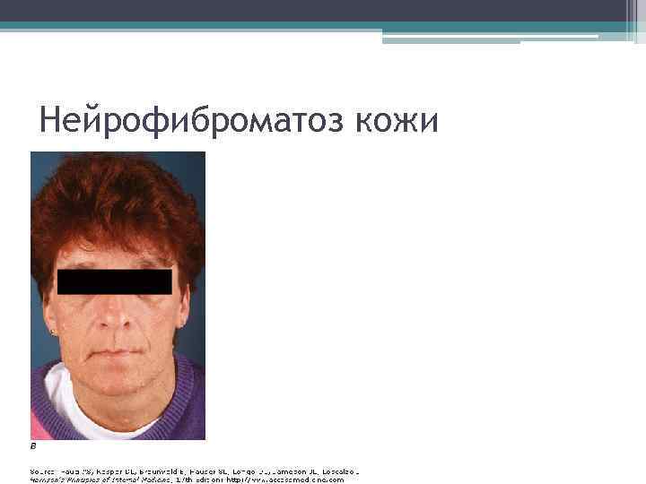 Нейрофиброматоз кожи 