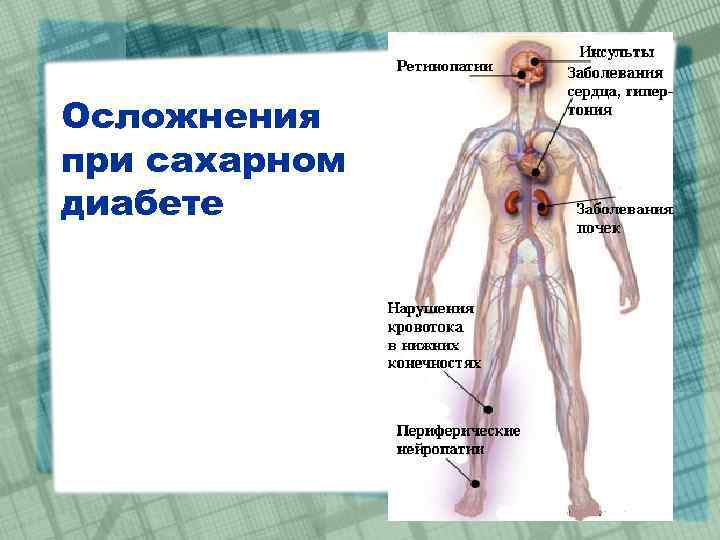 Осложнения при сахарном диабете 