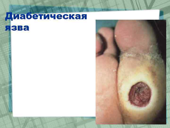 Диабетическая язва 