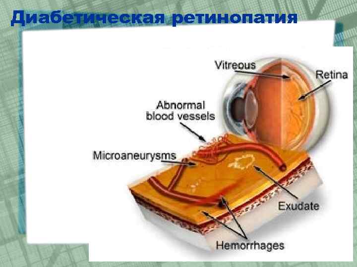 Диабетическая ретинопатия 