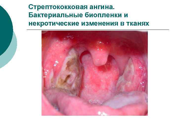 Стрептококковая ангина. Бактериальные биопленки и некротические изменения в тканях 
