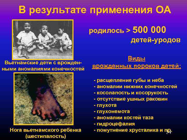 В результате применения ОА родилось > 500 000 детей-уродов Вьетнамские дети с врожденными аномалиями