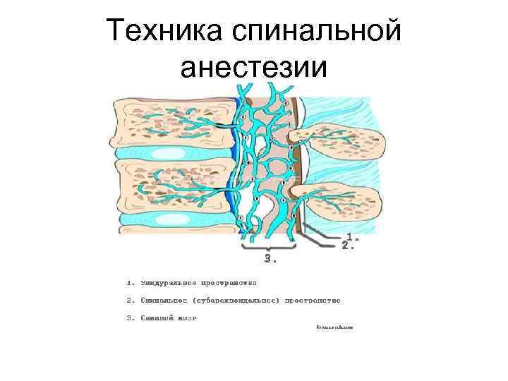 Техника спинальной анестезии 