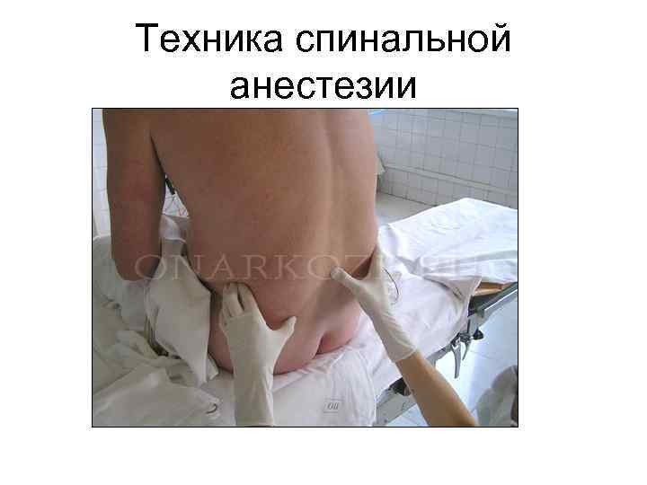 Техника спинальной анестезии 