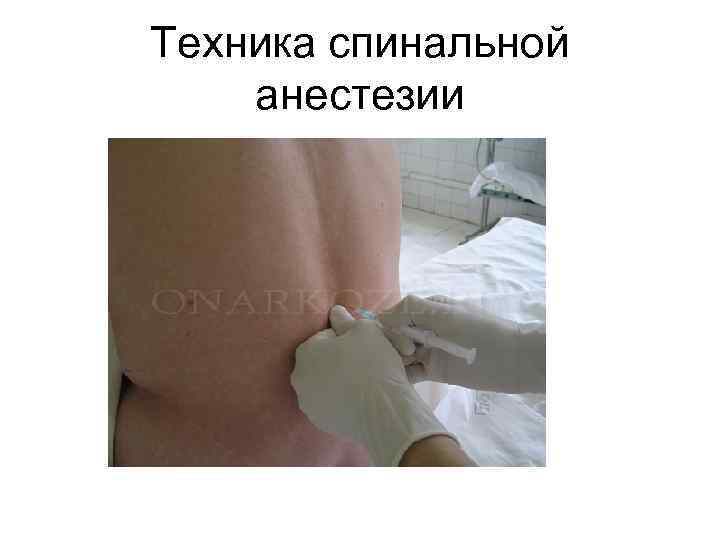 Техника спинальной анестезии 
