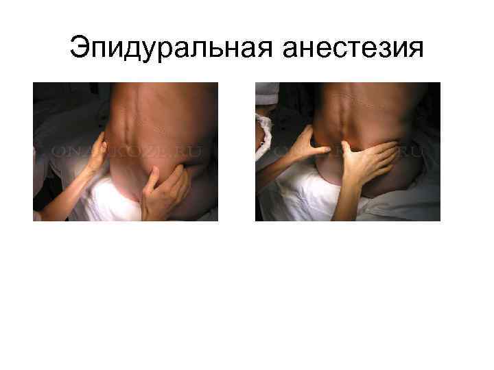 Эпидуральная анестезия 