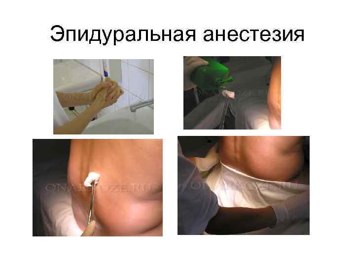 Эпидуральная анестезия 