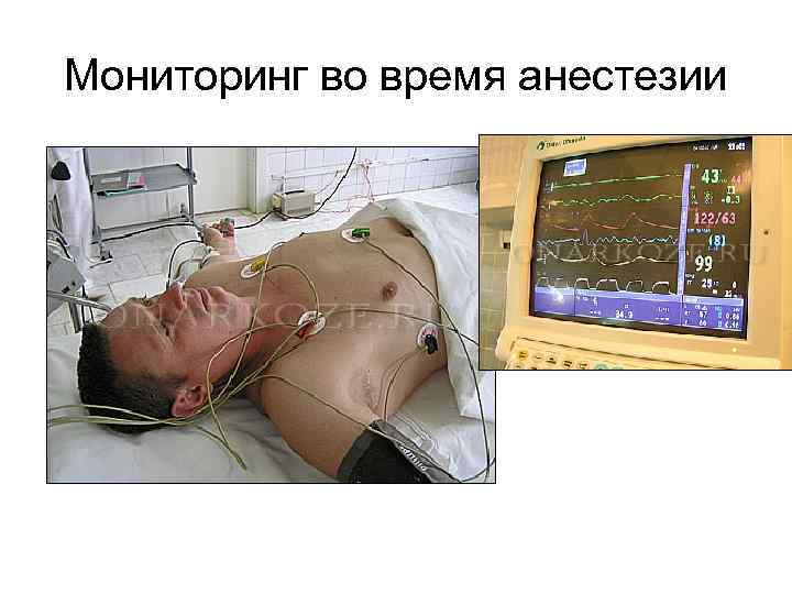 Мониторинг во время анестезии 