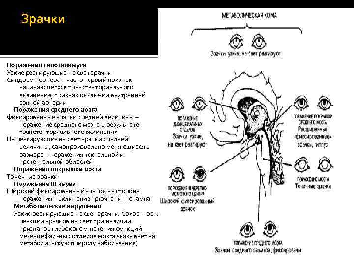Зрачки Поражения гипоталамуса Узкие реагирующие на свет зрачки Синдром Горнера – часто первый признак