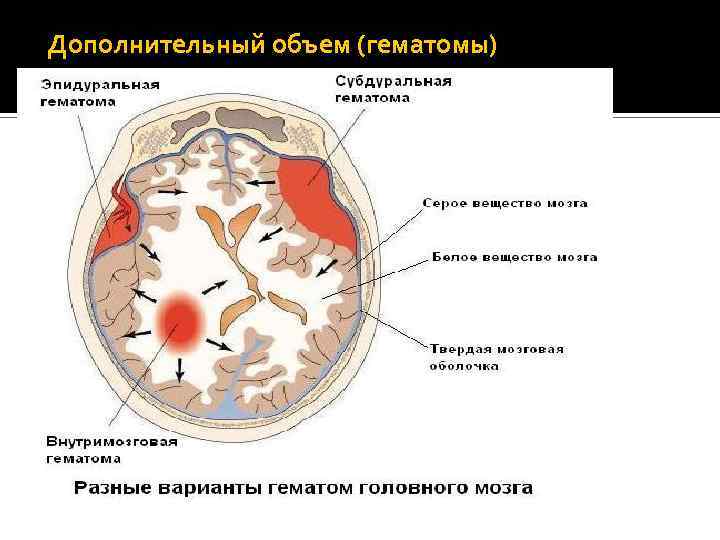 Дополнительный объем (гематомы) 