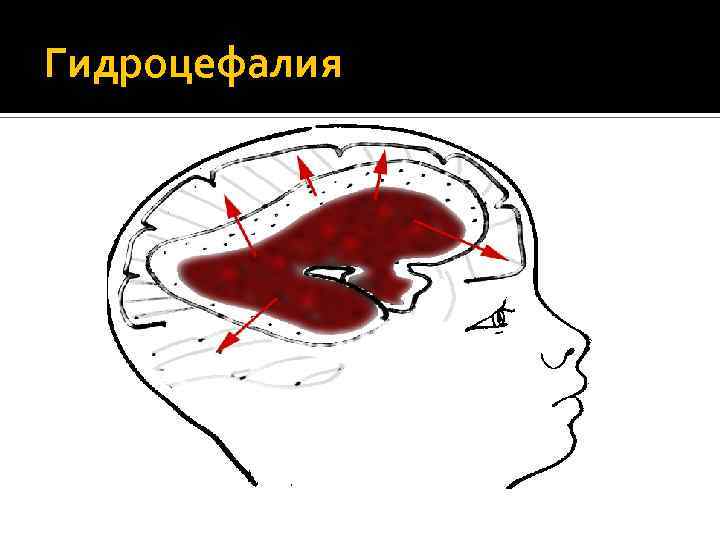 Гидроцефалия 