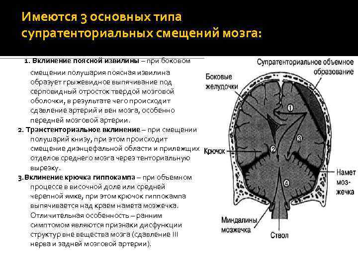 Срединные структуры. Дислокация ствола головного мозга. Поперечная дислокация головного мозга. Вклинение ствола головного мозга. Типы вклинения головного мозга таблица.