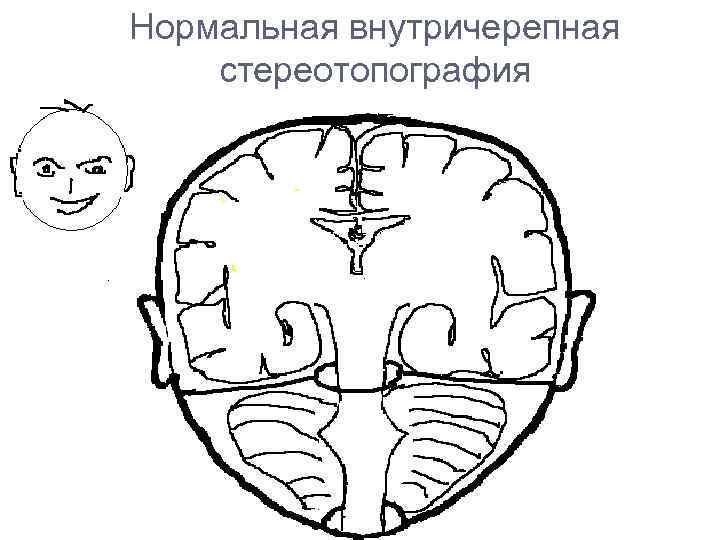 Нормальная внутричерепная стереотопография 