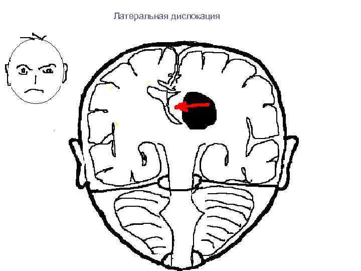 Латеральная дислокация 