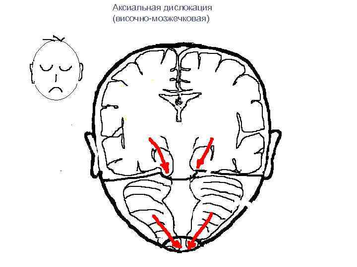 Аксиальная дислокация (височно-мозжечковая) 