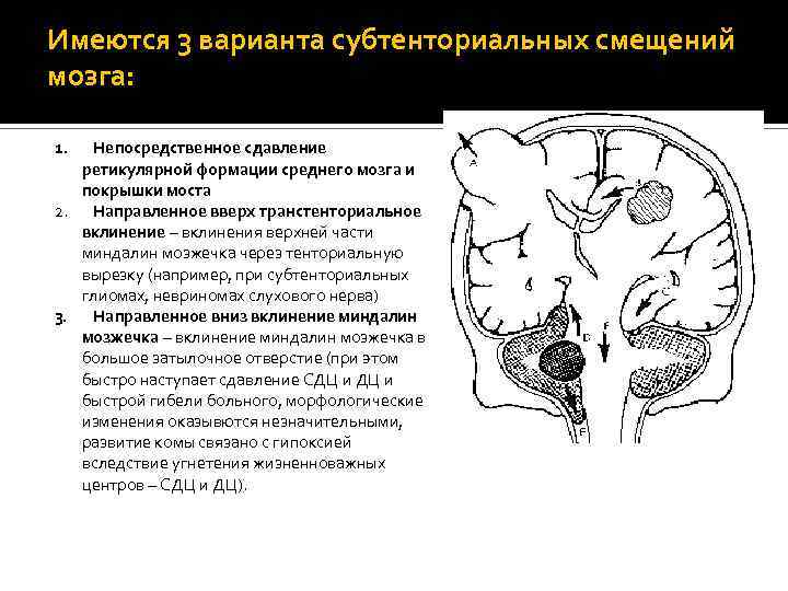 Имеются 3 варианта субтенториальных смещений мозга: 1. Непосредственное сдавление ретикулярной формации среднего мозга и