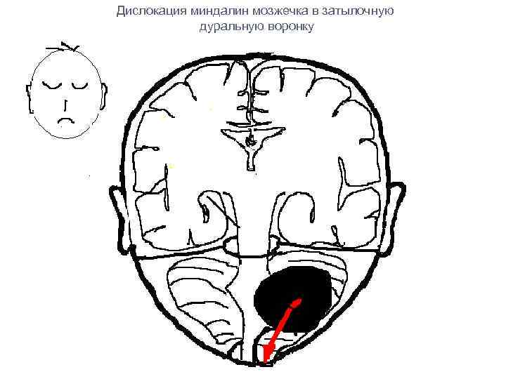 Миндалины мозжечка. Дислокация миндалин мозжечка. Вклинение миндалин мозжечка в большое затылочное отверстие на кт. Миндалины мозжечка расположены. Линия Чемберлена миндалины мозжечка.