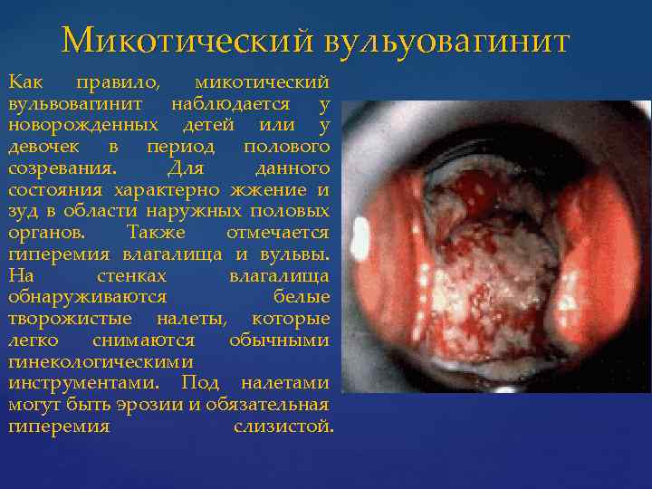 Микотический вульуовагинит Как правило, микотический вульвовагинит наблюдается у новорожденных детей или у девочек в