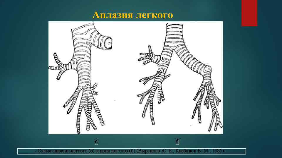 Аплазия легкого 