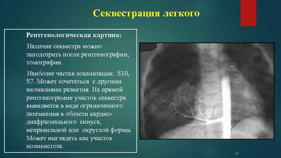 Наиболее частой локализацией. Экстралобарная секвестрация легкого. Легочная секвестрация рентген. Секвестрация левого легкого. Абсцесс легкого с секвестрацией.