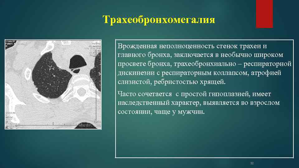 Трахеобронхомегалия Врожденная неполноценность стенок трахеи и главного бронха, заключается в необычно широком просвете бронха,