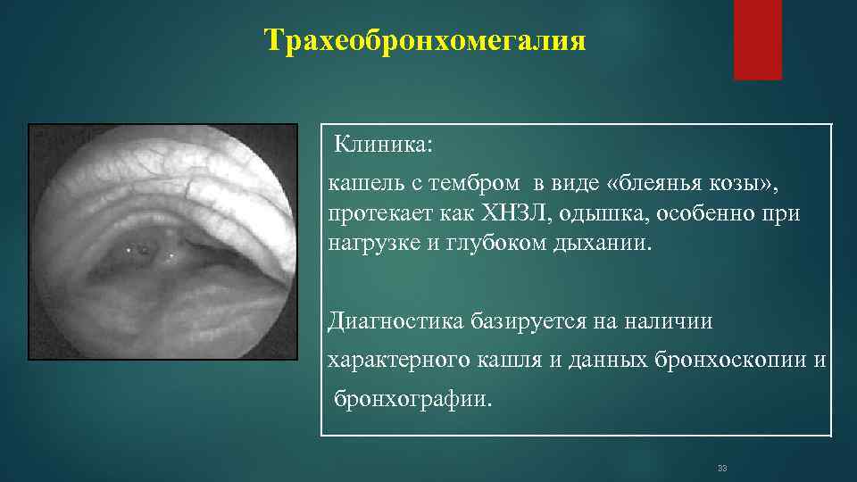 Трахеобронхомегалия Клиника: кашель с тембром в виде «блеянья козы» , протекает как ХНЗЛ, одышка,