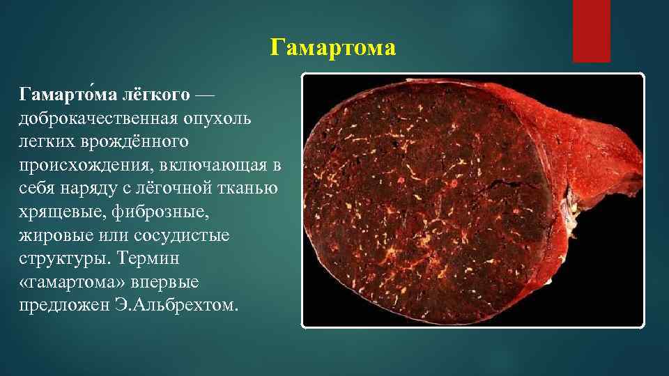 Доброкачественные опухоли легких презентация