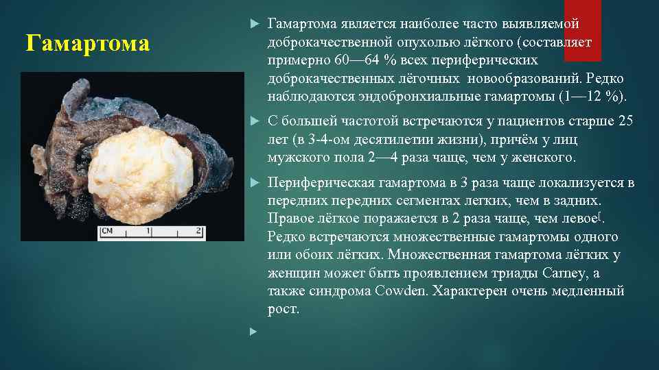 Гамартома является наиболее часто выявляемой доброкачественной опухолью лёгкого (составляет примерно 60— 64 % всех