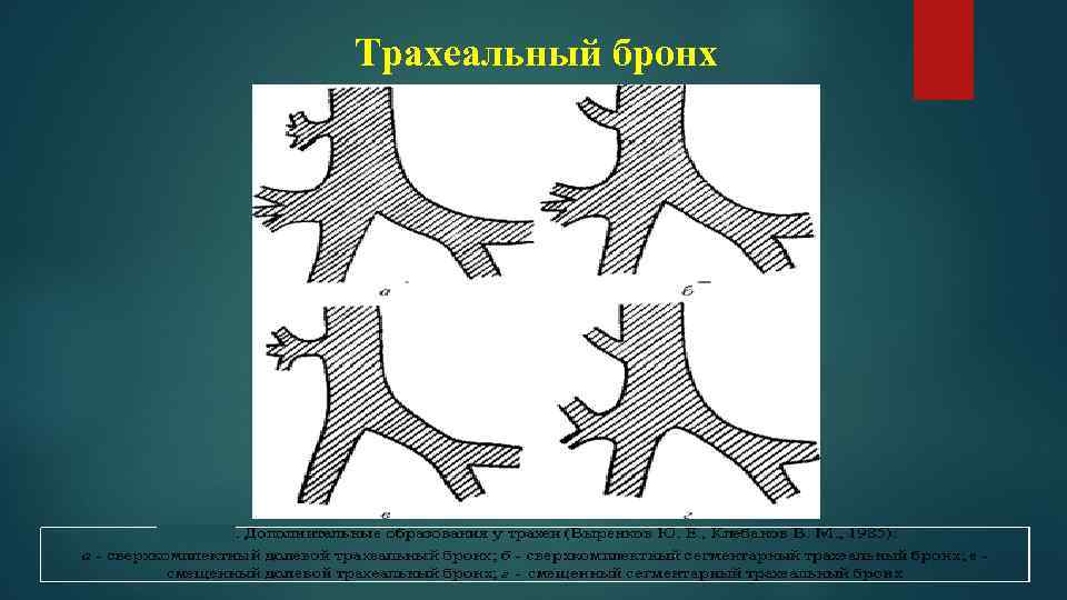 Пороки Развития Трахеи