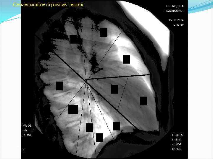 Сегментарное строение легких 1 1 1 2 3 6 4 5 10 8 9