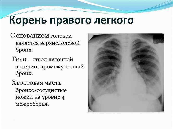 Корень правого легкого Основанием головки является верхнедолевой бронх. Тело – ствол легочной артерии, промежуточный