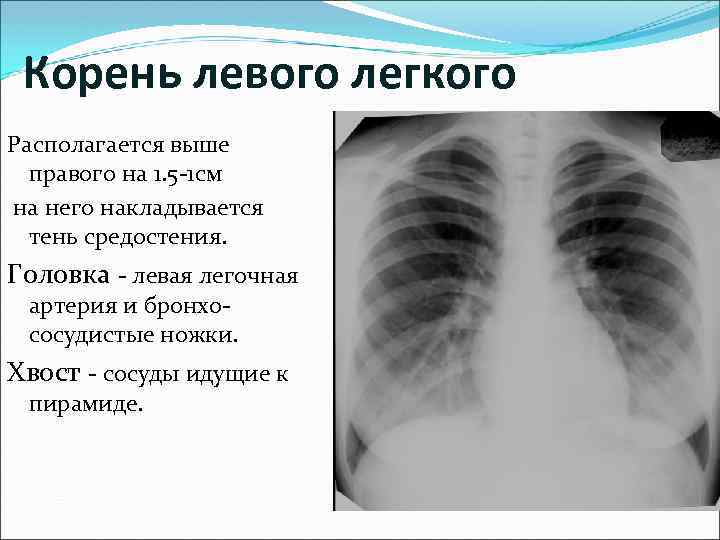 Корень левого легкого Располагается выше правого на 1. 5 -1 см на него накладывается