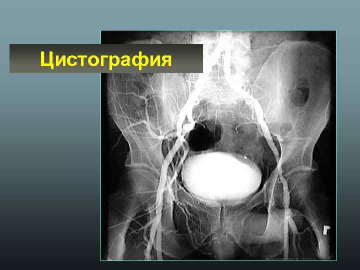 Цистография 