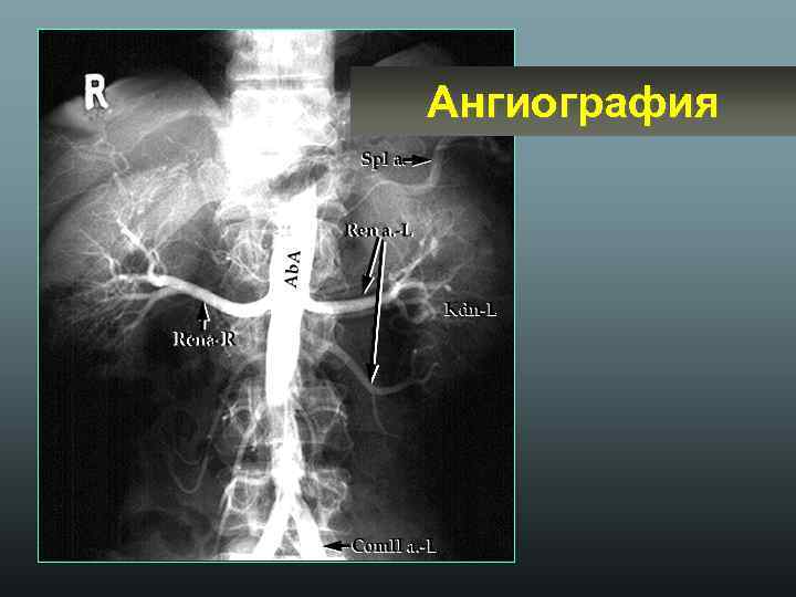 Ангиография 