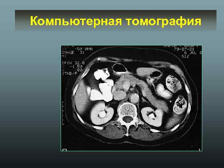 Компьютерная томография 
