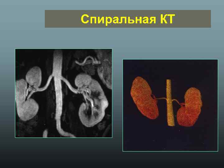 Спиральная КТ 