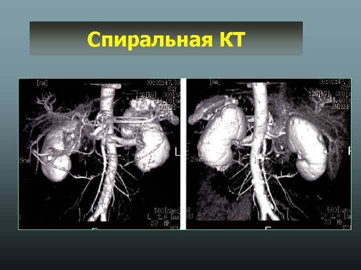 Спиральная КТ 