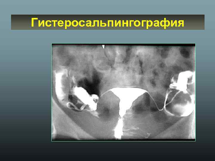 Гистеросальпингография 