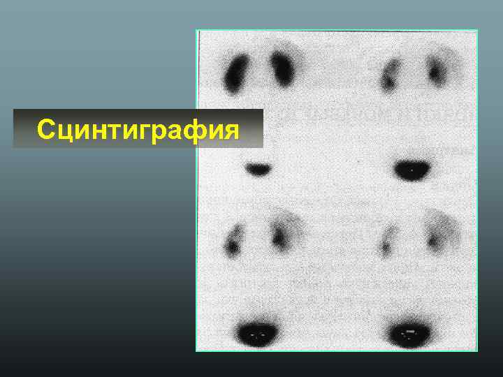 Сцинтиграфия 